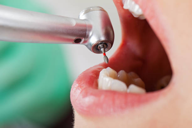 Best Broken or Cracked Tooth Emergency Dentist in Nice, CA